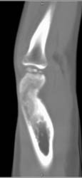 Irregularity Humerus Epiphysis - CTisus CT Scan