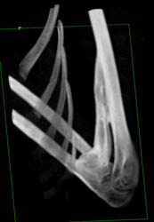 Fusion of Bone With Heterotopic Calcification - CTisus CT Scan