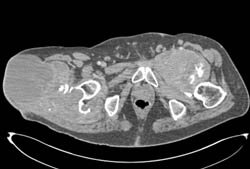 Amyloidosis in Paraplegic Patient - CTisus CT Scan