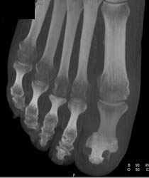 Ulcer With Osteomyelitis First Digit - CTisus CT Scan