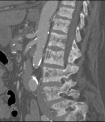 Metastatic Disease to Bone - CTisus CT Scan