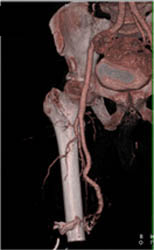 AKA (above-the-knee amputation) With CTA - CTisus CT Scan