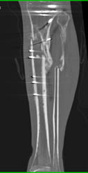 Nonunion Tibial Fracture - CTisus CT Scan