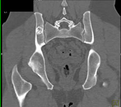 Benign Lesion Iliac Bone - CTisus CT Scan