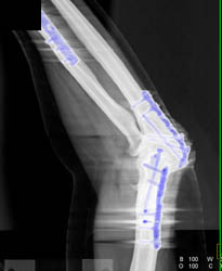 Plates With Ulna and Radial Fractures - CTisus CT Scan