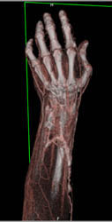 Heterotopic Calcification - CTisus CT Scan