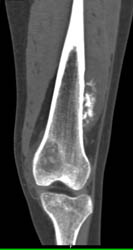 Osteogenic Sarcoma - CTisus CT Scan