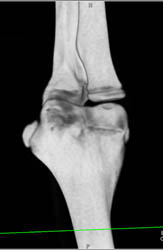 Cortical Defect in Humerus - CTisus CT Scan