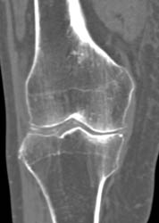 Meniscal Calcification - CTisus CT Scan