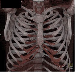 Costal Cartilage - CTisus CT Scan