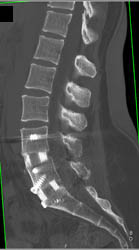 Bony Fusion - CTisus CT Scan