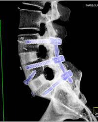 Hardware for Fusion - CTisus CT Scan