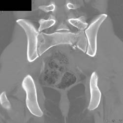 Sacral Fracture - CTisus CT Scan