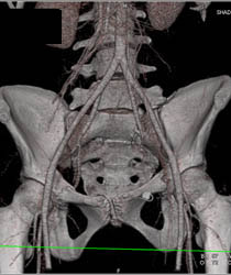 Sacral Fracture - CTisus CT Scan