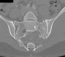 Sacral Fracture - CTisus CT Scan