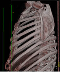 Pectus Deformity - CTisus CT Scan