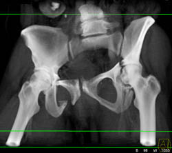 Pelvis Fractures and Disruption of the Pelvic Ring - CTisus CT Scan