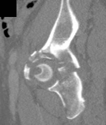 Acetabula Fractures - CTisus CT Scan