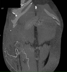 Inferior Epigastric Artery for DIEP Flap Surgery - CTisus CT Scan