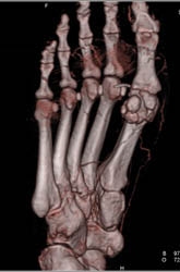 Infection 1st Toe in 3D Display - CTisus CT Scan