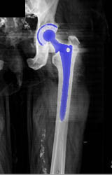 Hip Arthroplasty - CTisus CT Scan