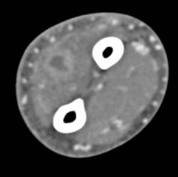 Abscess - CTisus CT Scan