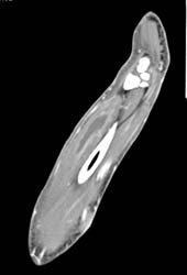 Abscess - CTisus CT Scan