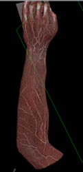 Cellulitis - CTisus CT Scan