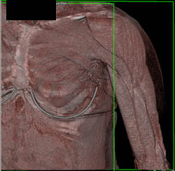 Muscle Anatomy - CTisus CT Scan