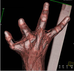 Fusion of Digits - CTisus CT Scan