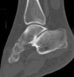 Tarsal Coalition - CTisus CT Scan