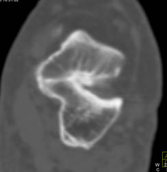 Tarsal Coalition - CTisus CT Scan