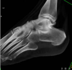 Tarsal Coalition - CTisus CT Scan