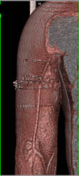 Humerus GSW and Fractures - CTisus CT Scan