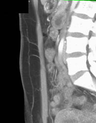 DIEP Flap Planning - CTisus CT Scan