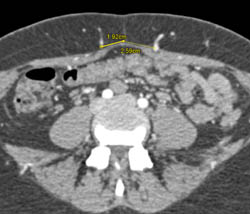 DIEP Flap Planning - CTisus CT Scan