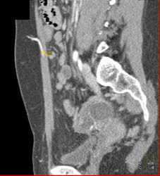 DIEP Flap Planning - CTisus CT Scan