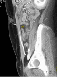 DIEP Flap Planning - CTisus CT Scan