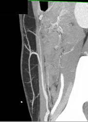 DIEP Flap Planning - CTisus CT Scan