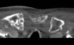 Degenerative Joint Disease (DJD) Right Clavicular Head With Inflammation - See Soft Tissue 3Ds Also - CTisus CT Scan