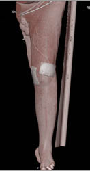 Thigh Swelling and Amputated But Reimplanted Toes - CTisus CT Scan