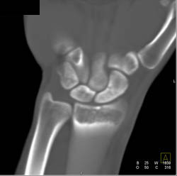 Scaphoid Fracture - CTisus CT Scan