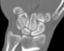 Scaphoid Fracture - CTisus CT Scan