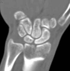 Scaphoid Fracture - CTisus CT Scan