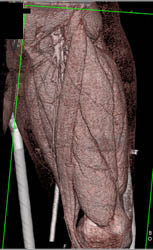 Femur Fracture With Overlap - CTisus CT Scan