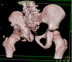 Right Hip and Acetabular Dysplasia - CTisus CT Scan