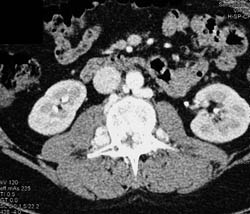 Huge Collaterals Along Spine and Aorta - CTisus CT Scan