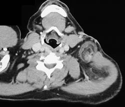 Liposarcoma - CTisus CT Scan