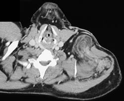 Liposarcoma - CTisus CT Scan