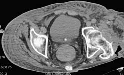 Lymphedema - CTisus CT Scan